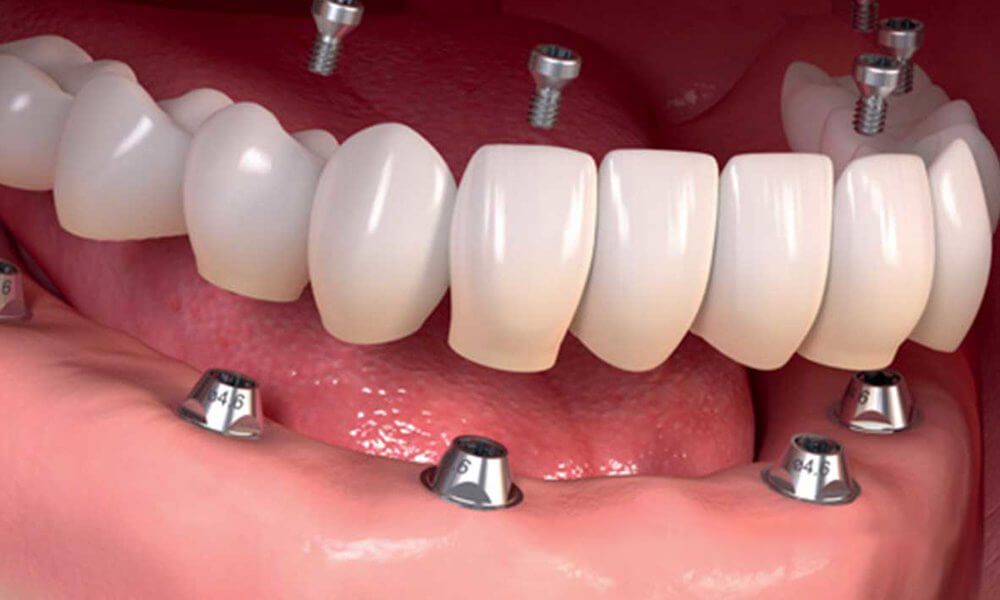 ParamountDentalSydneyFullMouthDentalImplants2 1