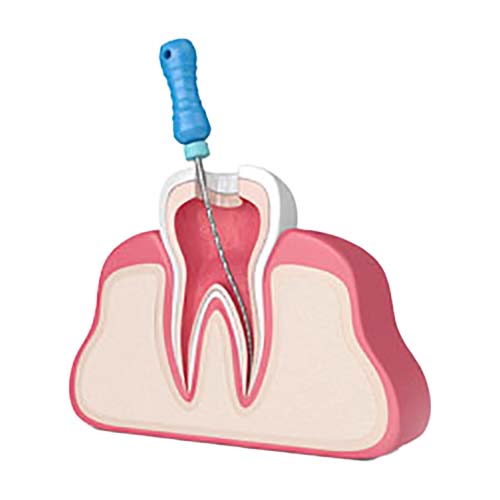 Root Canal in 3d