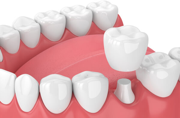 dental crown in 3d