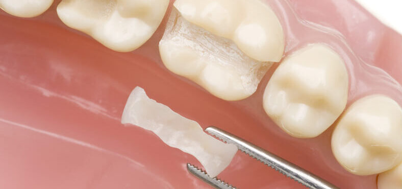 bonded fillings applied to tooth