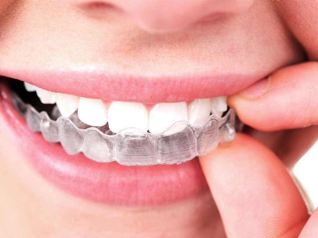 Invisalign Cost - Big Smile Dental