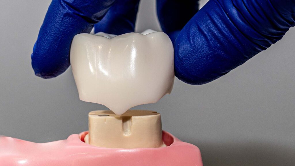 Dental crown example
