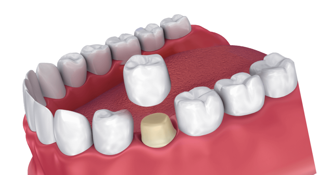 dental crown in 3d