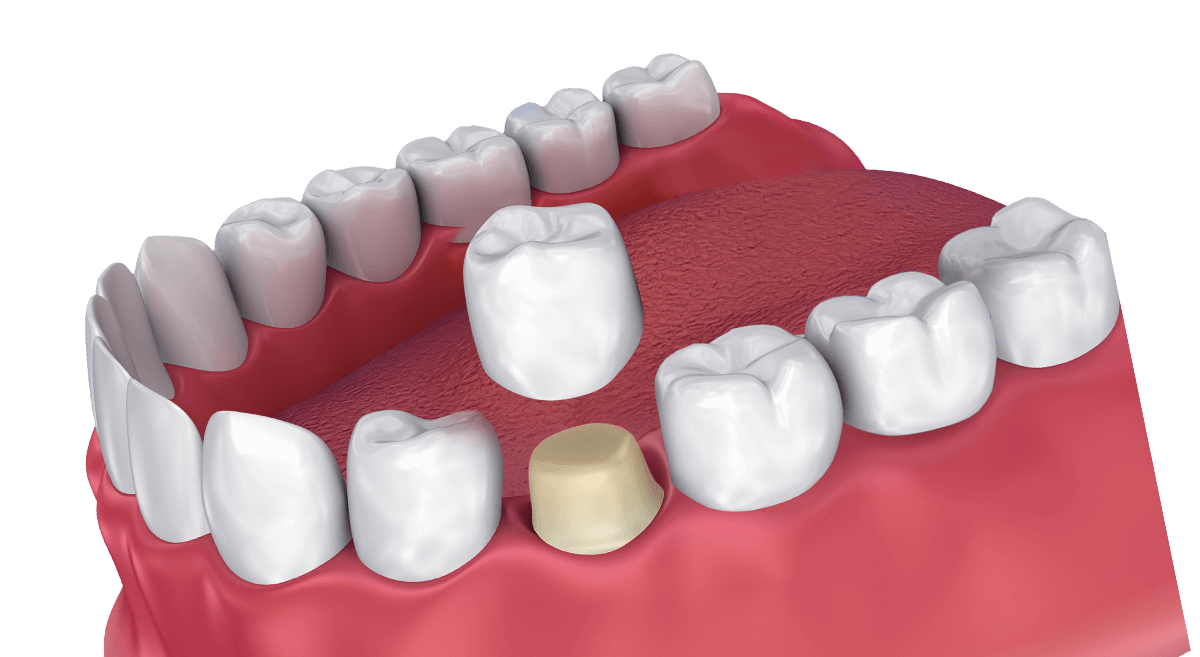 Tooth Crowns | Smiles Dental Group | Edmonton