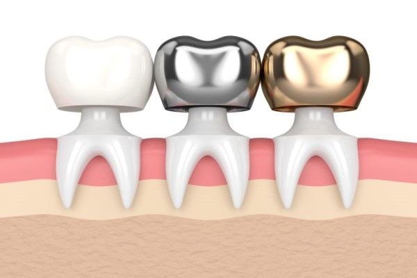 silver gold and porcelain dental crowns