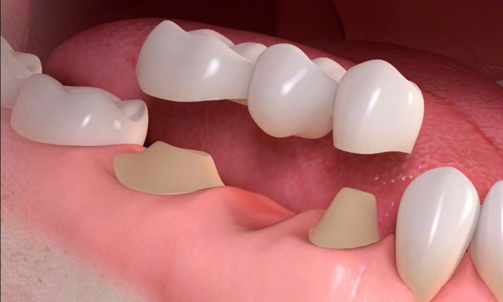 dental bridge in 3d