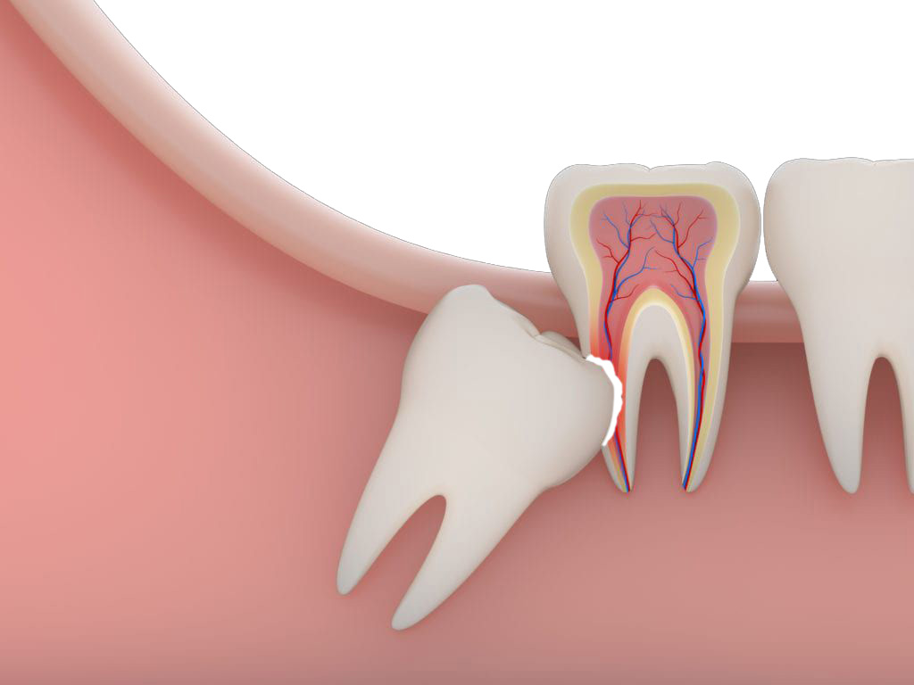 impacted wisdom tooth