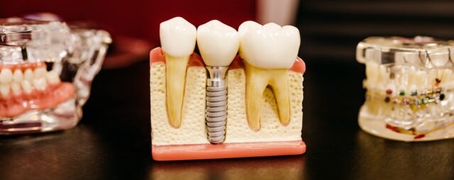 dental implants edmonton