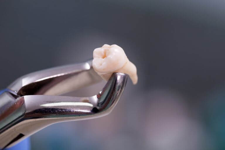 Wisdom Teeth Extractions in Edmonton - 3 - Smiles Dental Group