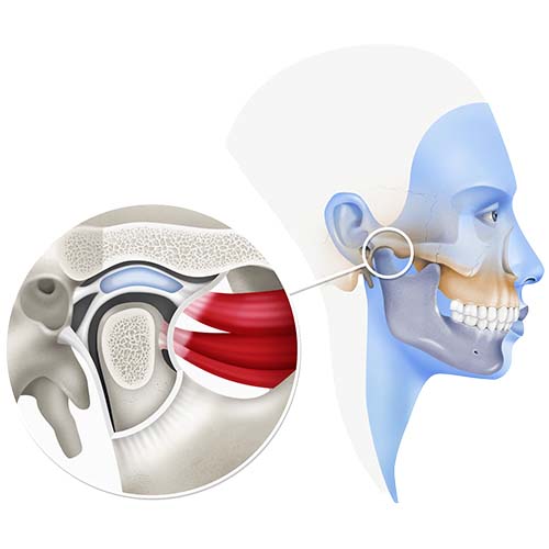 Temporomandibular Joint (TMJ) example