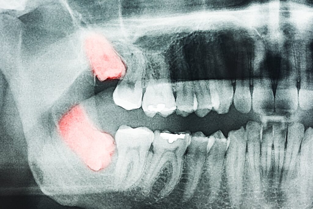 wisdom tooth x-ray - left