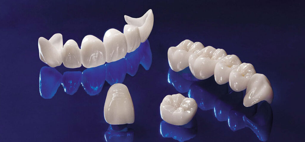 dental bridges and crowns