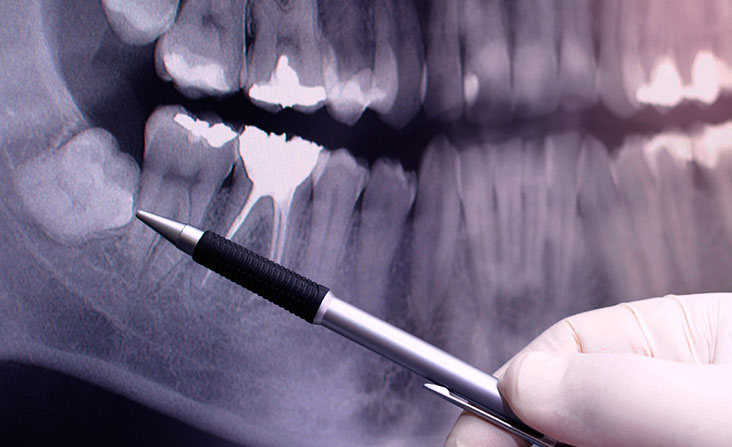 wisdom tooth extraction