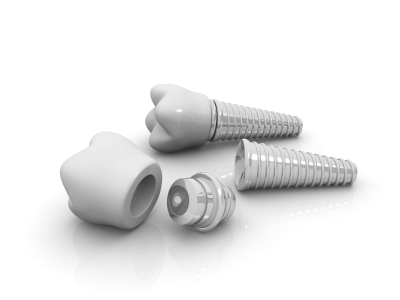 Dental Implants - Types, Recovery, Aftercare - 1 - Smiles Dental Group