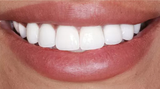 after image teeth whitening