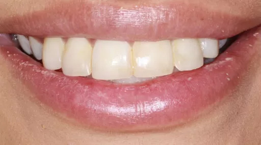before image teeth whitening