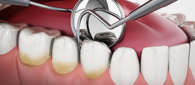 Teeth Scaling & Root Planing - is it worth it? - 3 - Smiles Dental Group