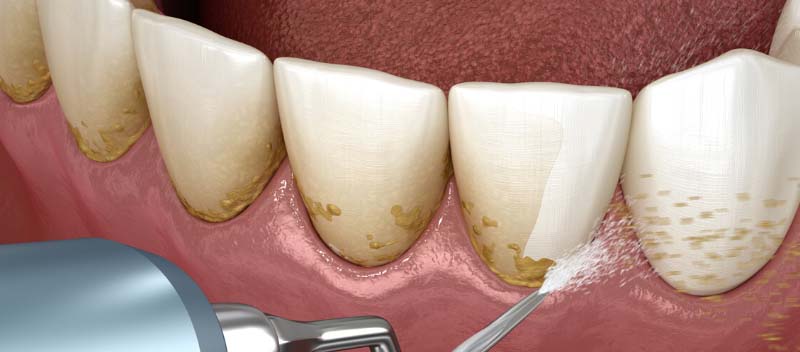 Teeth Scaling & Root Planing - is it worth it? - 1 - Smiles Dental Group