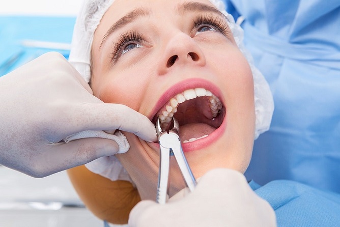 Root Canals - All You Need To Know & Then Some - 5 - Smiles Dental Group
