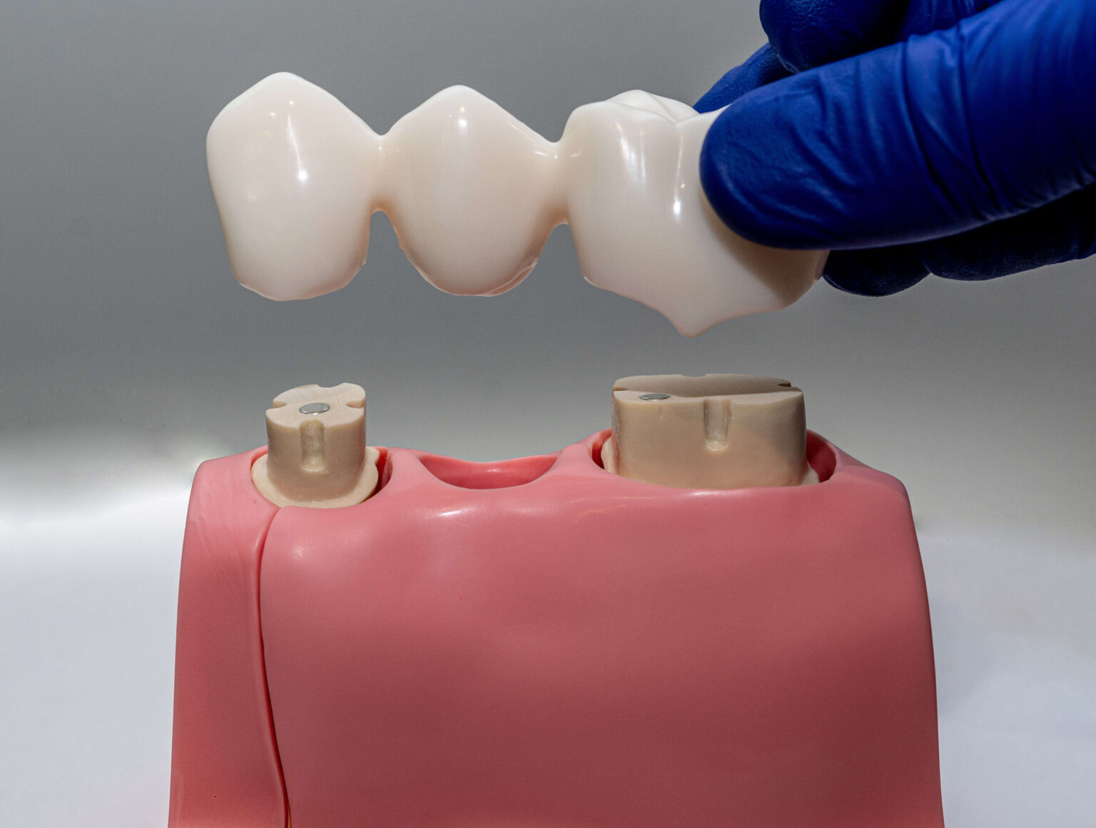 Dental Bridge Types, Benefits, Procedures Smiles Dental Group