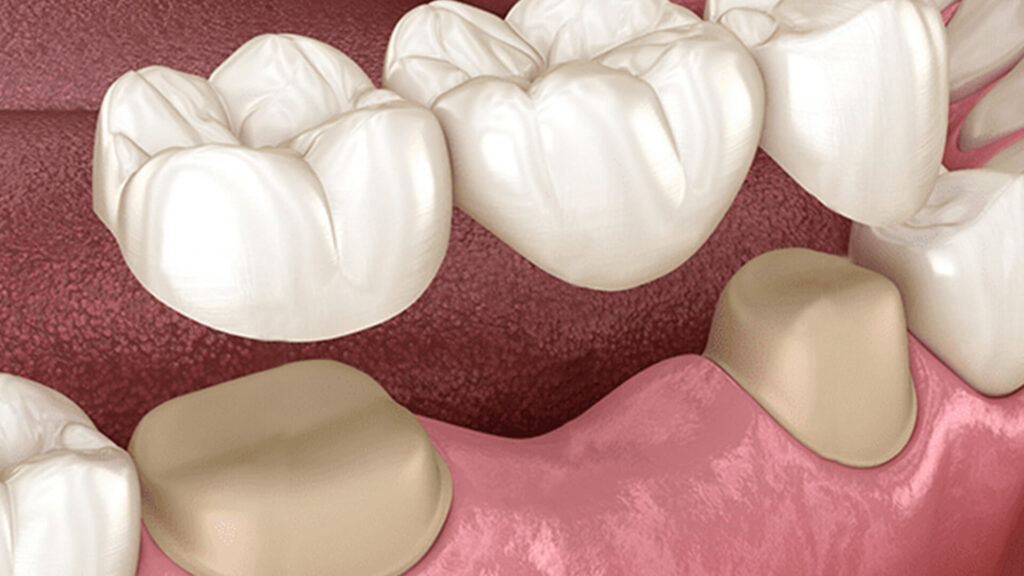 Dental Bridges – What You Need To Know - 1 - Smiles Dental Group