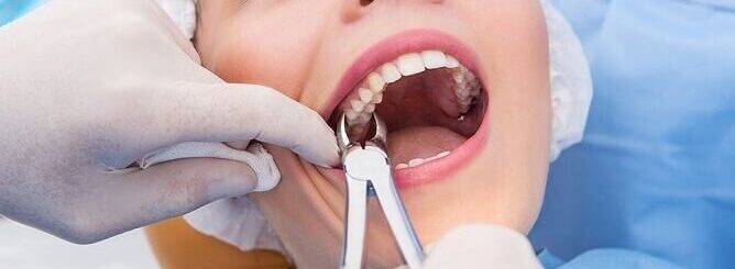 Tooth Extractions - Everything You Need To Know - 3 - Smiles Dental Group