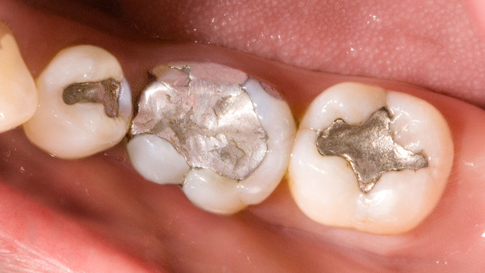 Crowns - What You Need To Know! - 11 - Smiles Dental Group