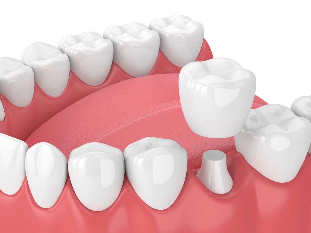 Crowns - What You Need To Know! - 1 - Smiles Dental Group