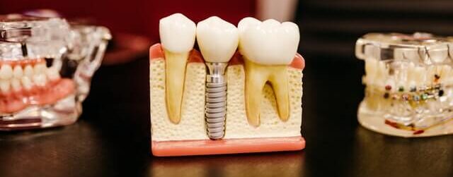 dental implants edmonton