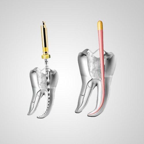 Root Canal in 3d