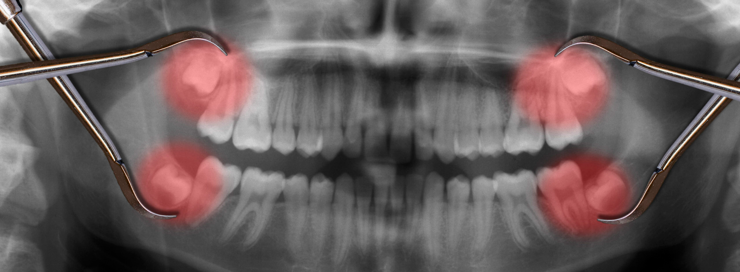 Wisdom tooth x-ray