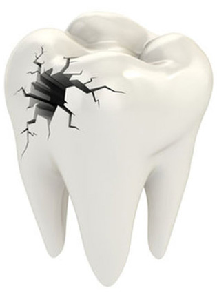 Cracked Molar Pain - What Can You Do? - 2 - Smiles Dental Group