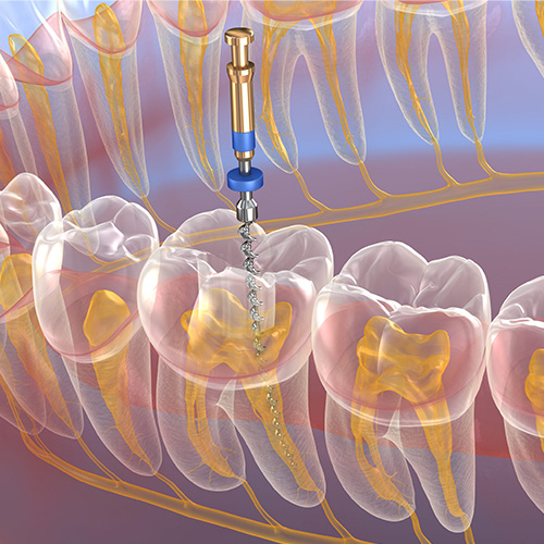 Root Canal Treatment, Smiles Dental Group