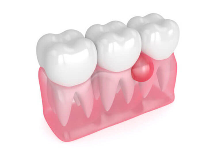 Dental abscess 1 1