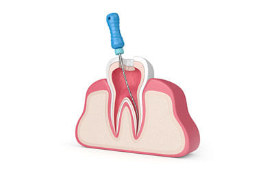 root canal illustration 2 1