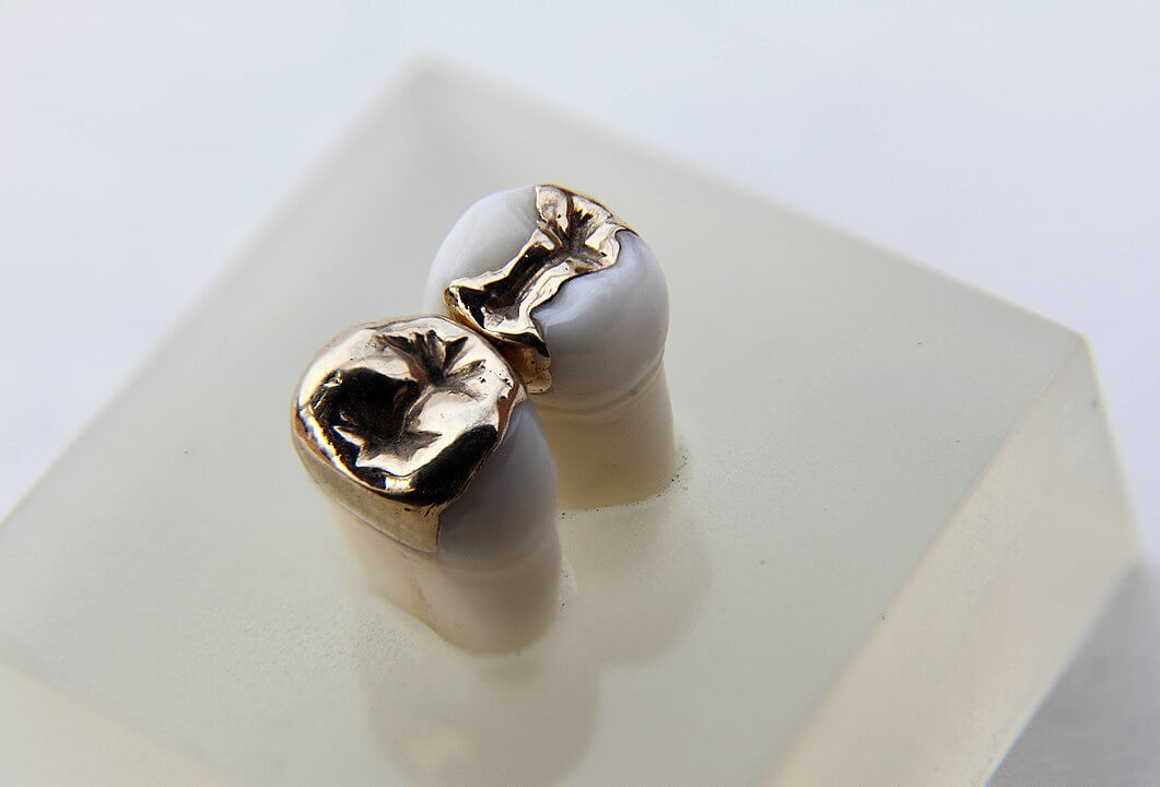 Inlays & Onlays - Materials, Reasons, Aftercare | Smiles Dental Group