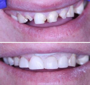 veneers bf