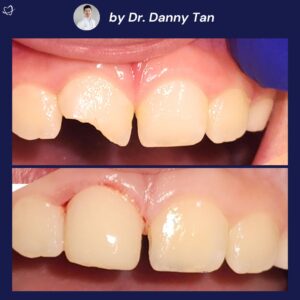 Copy of fillings (40)