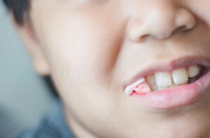 When to Stop Using Gauze After Tooth Extraction and Other Common Queries Hero