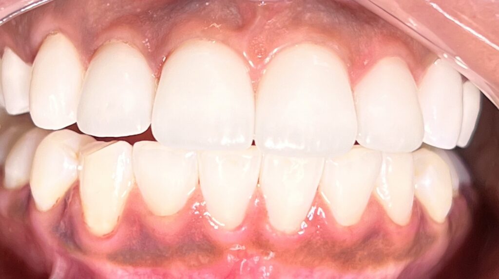 ashley callingbull veneers
