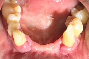partial denture to porcelain bridge